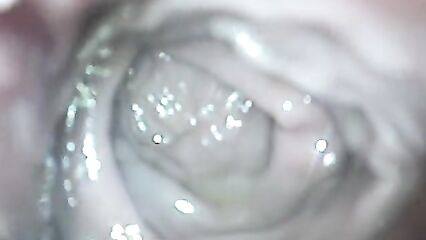 Исследование прямой кишки через анал камерой